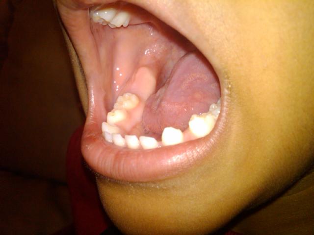 herpes pictures in mouth. herpes in his mouth